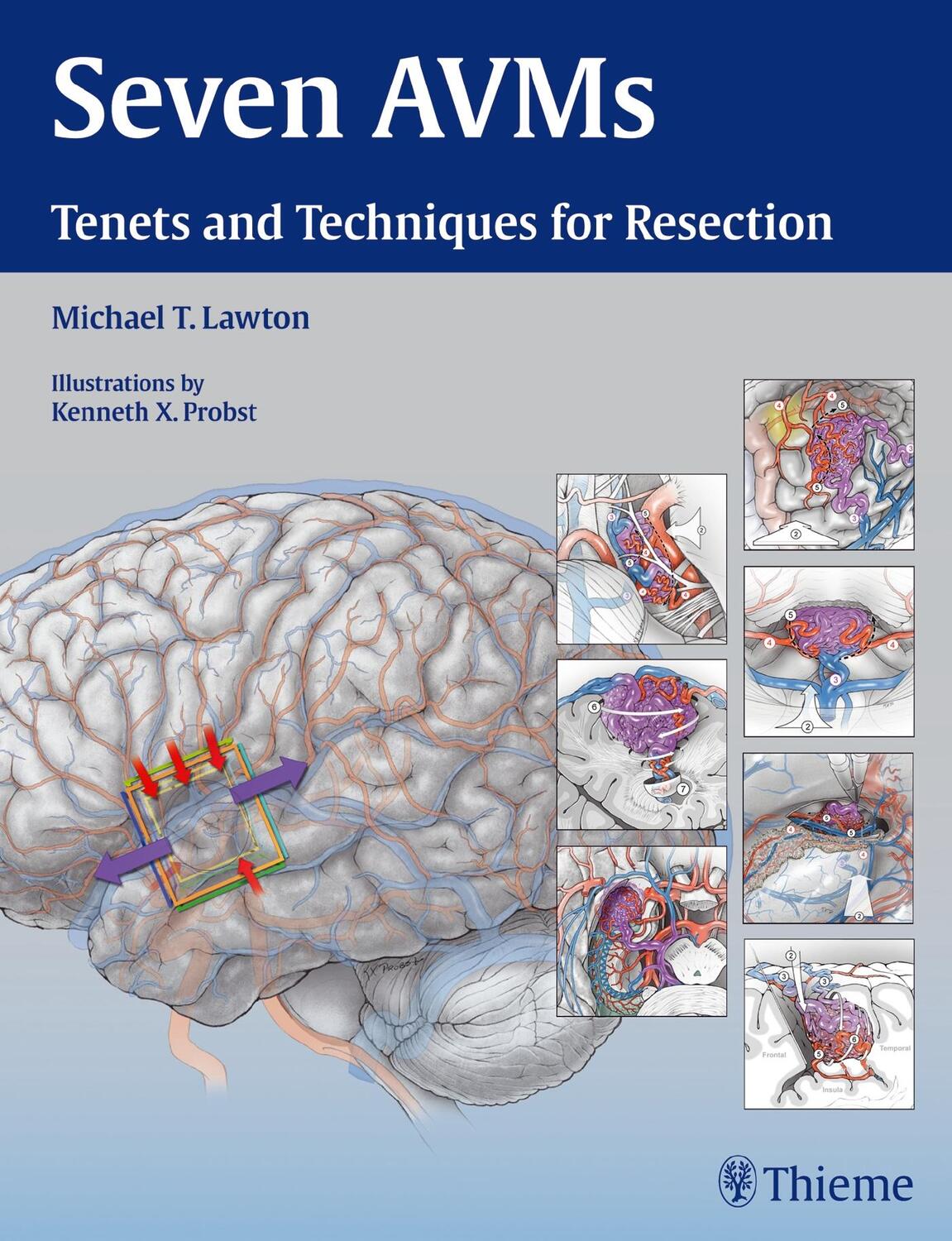 Cover: 9781604068757 | Seven AVMs | Tenets and Techniques for Resection | Buch | Englisch