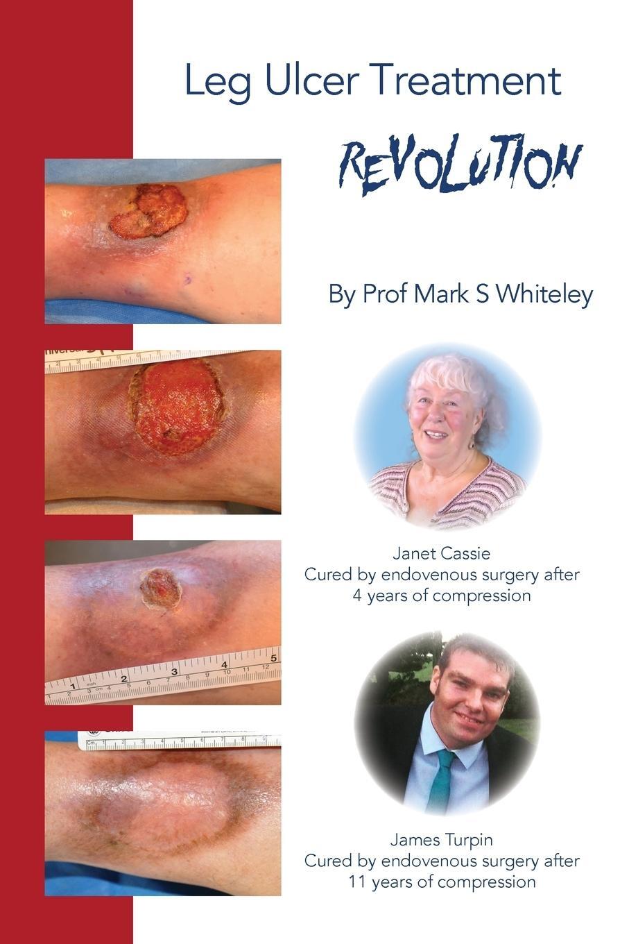 Cover: 9781908586056 | Leg Ulcer Treatment Revolution | Mark S Whiteley | Taschenbuch | 2018