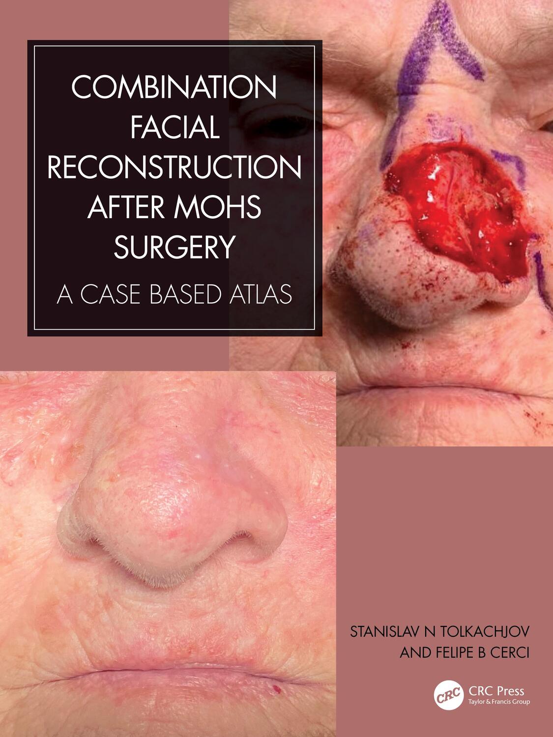 Cover: 9780367903183 | Combination Facial Reconstruction after Mohs Surgery | Buch | Englisch