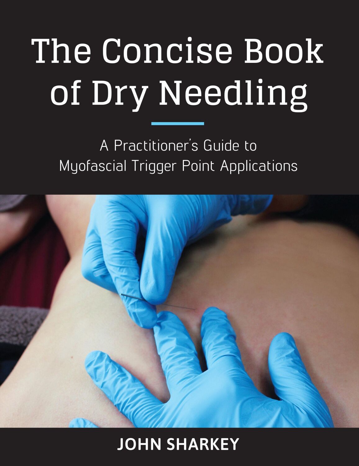 Cover: 9781623170837 | The Concise Book of Dry Needling | John Sharkey | Taschenbuch | 2017