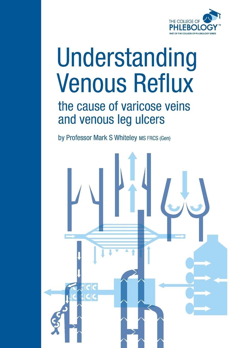 Cover: 9781908586001 | Understanding Venous Reflux the Cause of Varicose Veins and Venous...