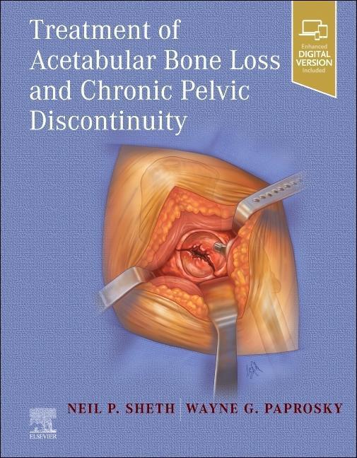 Cover: 9780323875509 | Treatment of Acetabular Bone Loss and Chronic Pelvic Discontinuity