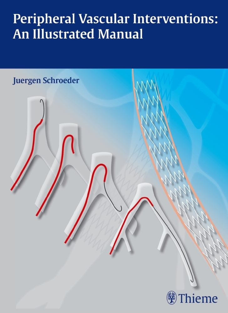 Cover: 9783131697516 | Peripheral Vascular Interventions: An Illustrated Manual | Schröder