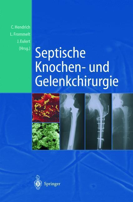 Cover: 9783642639289 | Septische Knochen-und Gelenkchirurgie | Christian Hendrich (u. a.)
