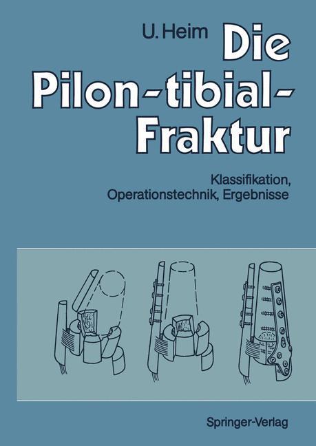 Cover: 9783642759604 | Die Pilon-tibial-Fraktur | Urs Heim | Taschenbuch | Paperback | XV