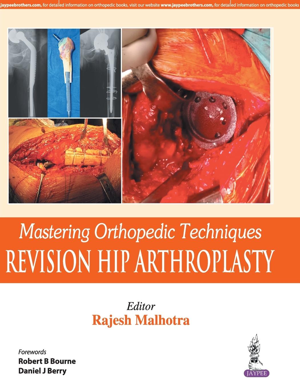 Cover: 9789351524861 | Mastering Orthopedic Techniques | Revision Hip Arthroplasty | Malhotra