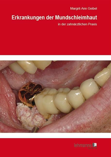 Cover: 9783865416117 | Erkrankungen der Mundschleimhaut | in der zahnärztlichen Praxis | Buch