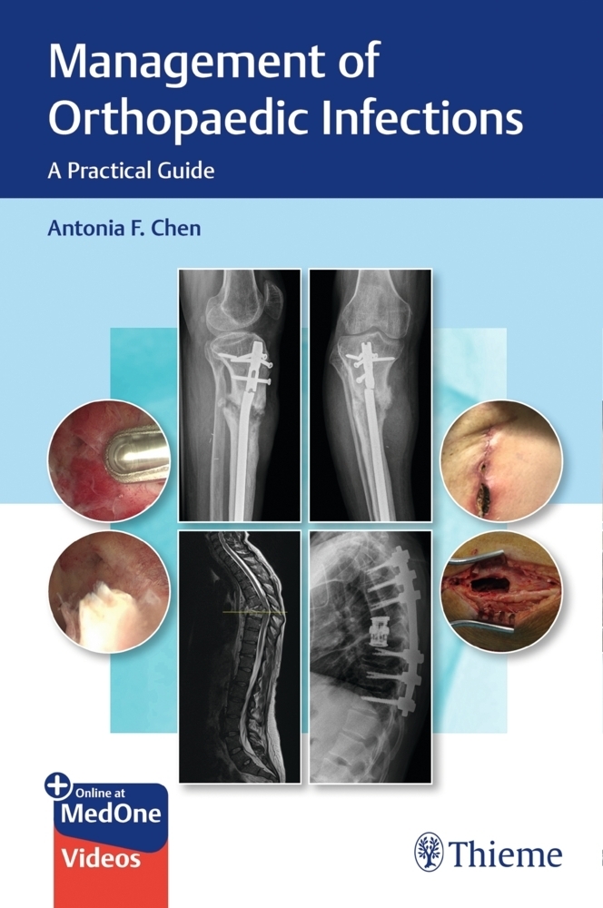 Cover: 9781684201334 | Management of Orthopaedic Infections | A Practical Guide | Chen | 2021