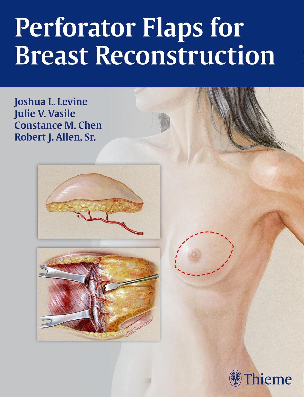 Cover: 9781626230941 | Perforator Flaps for Breast Reconstruction | Joshua L. Levine (u. a.)