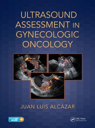 Cover: 9781138044326 | Ultrasound Assessment in Gynecologic Oncology | Juan Luis Alcazar