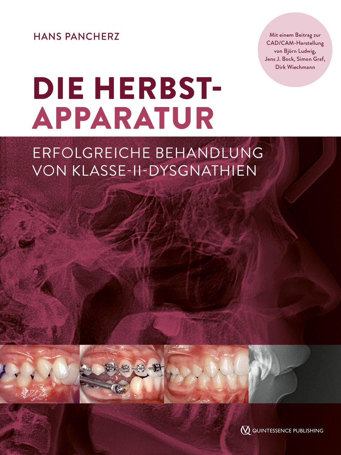 Cover: 9783868675849 | Die Herbst-Apparatur | Hans Pancherz | Buch | Deutsch | 2022
