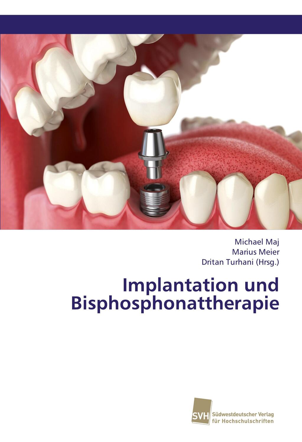 Cover: 9783838138886 | Implantation und Bisphosphonattherapie | Michael Maj (u. a.) | Buch