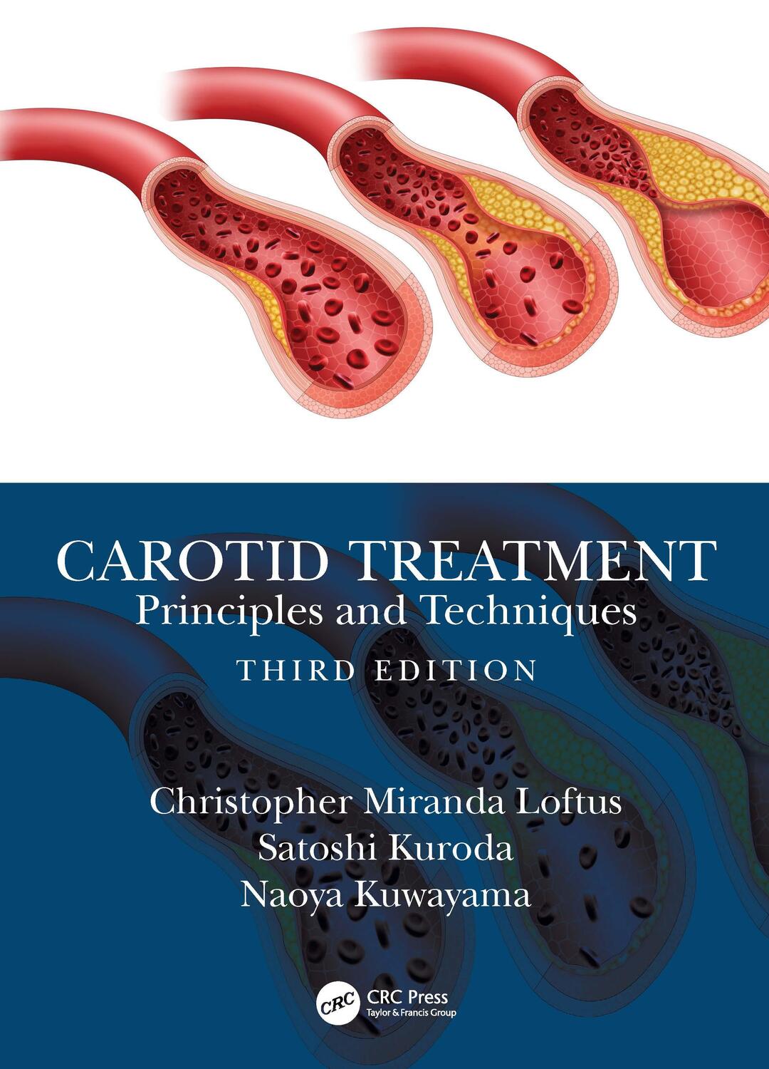 Cover: 9780367465711 | Carotid Treatment: Principles and Techniques | Loftus (u. a.) | Buch