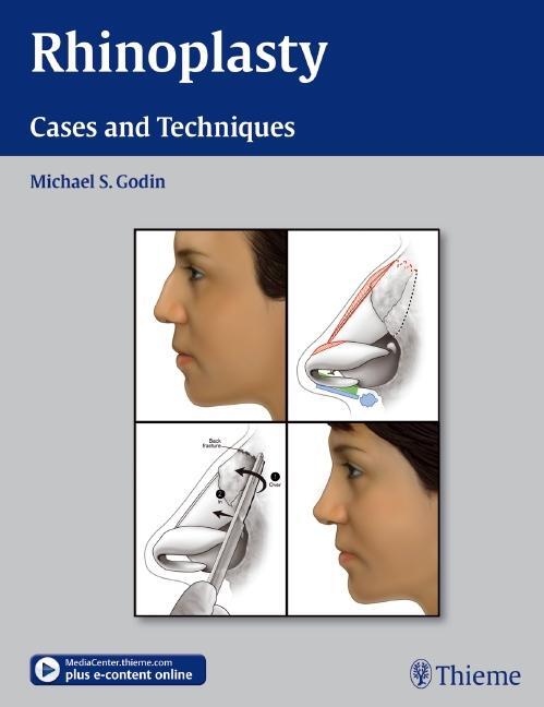 Cover: 9781604066807 | Rhinoplasty - Cases and Techniques: Cases and Techniques | Godin