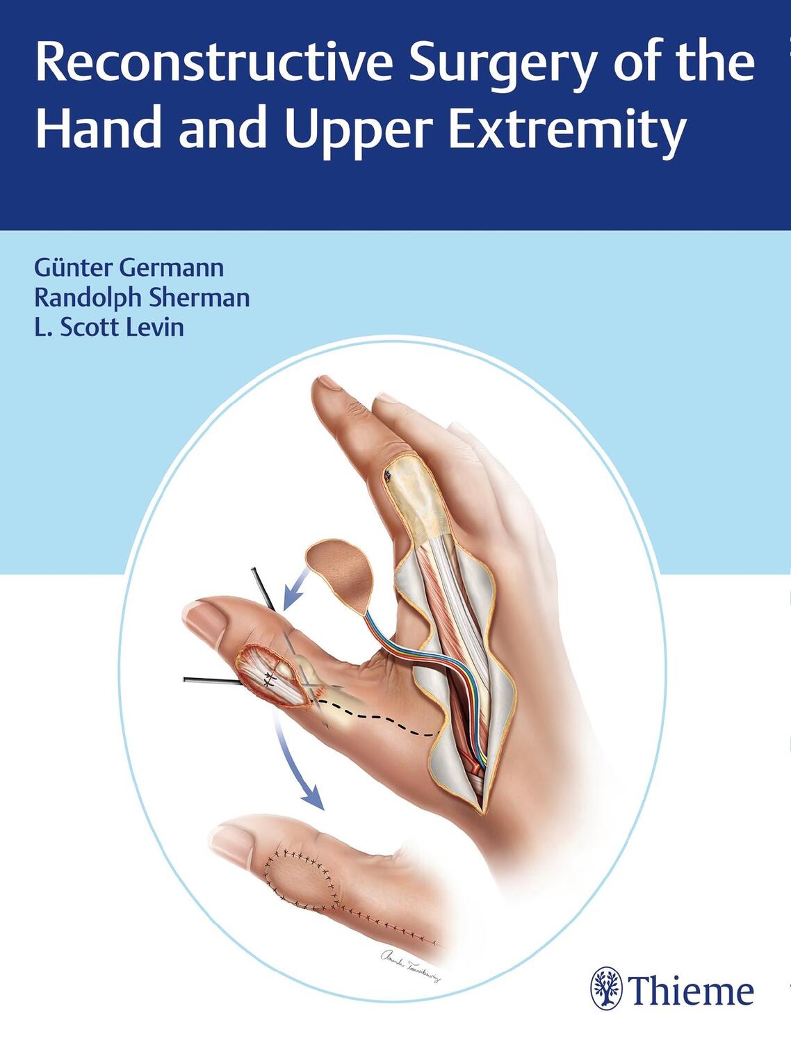 Cover: 9781626236011 | Reconstructive Surgery of the Hand and Upper Extremity | Bundle | 2017