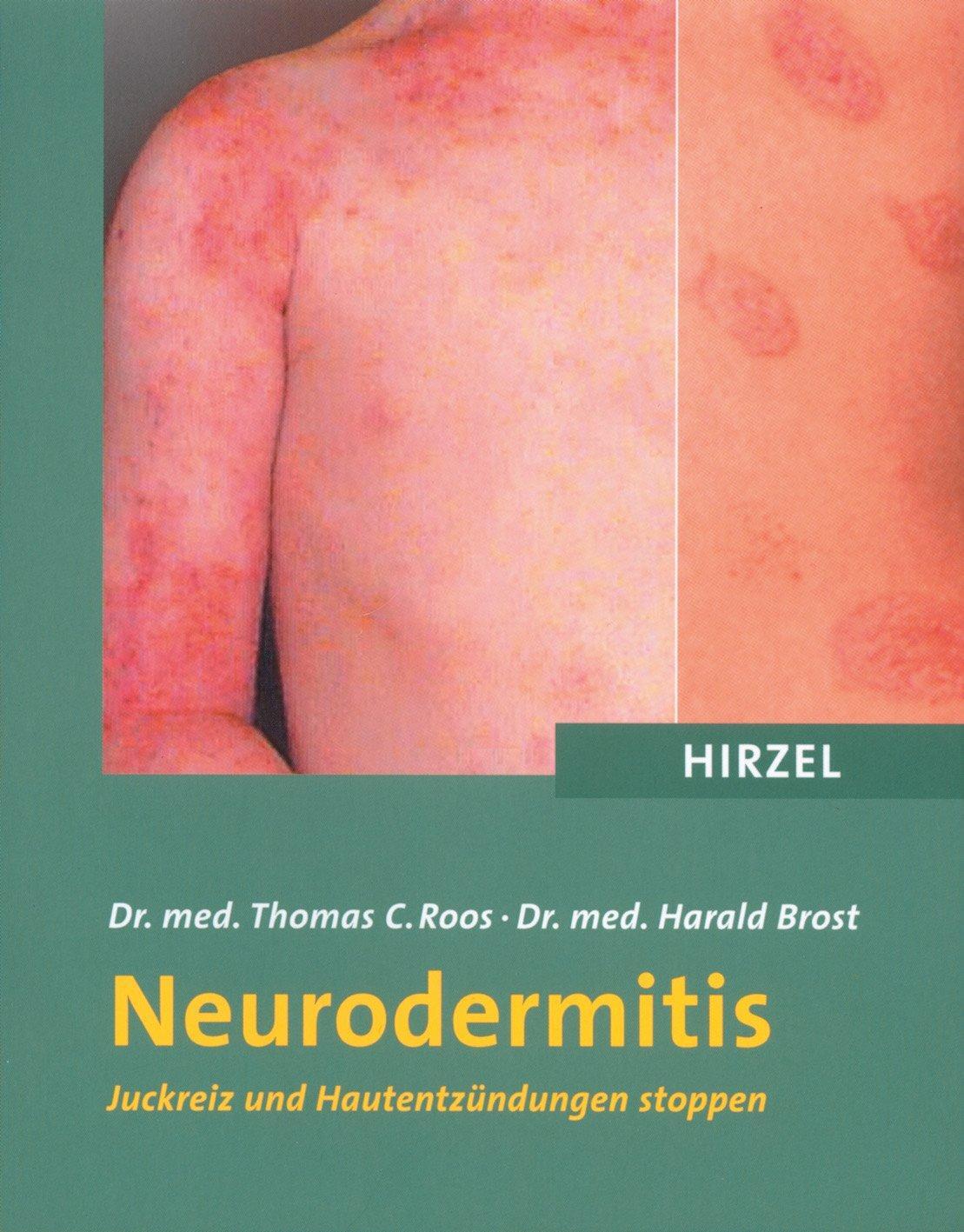 Cover: 9783777612638 | Neurodermitis | Juckreiz und Hautentzündungen stoppen | Roos (u. a.)