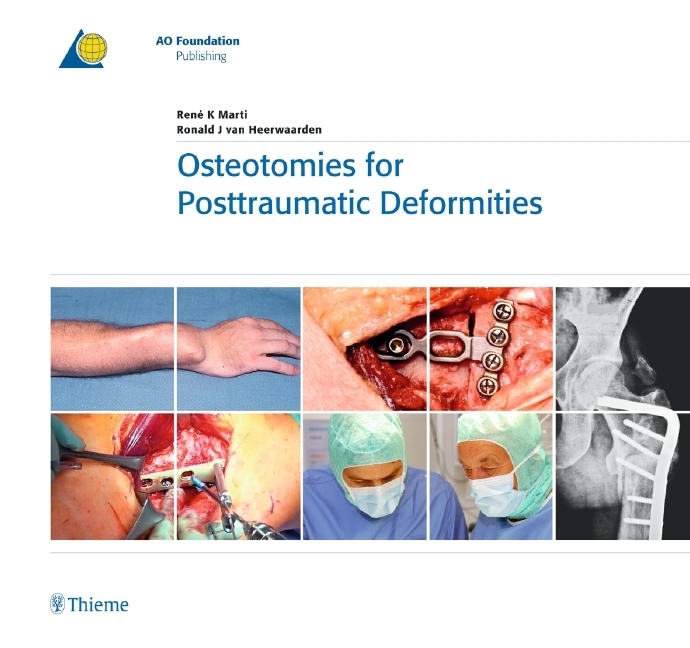 Cover: 9783131486714 | Osteotomies for Posttraumatic Deformities | René K. Marti (u. a.)