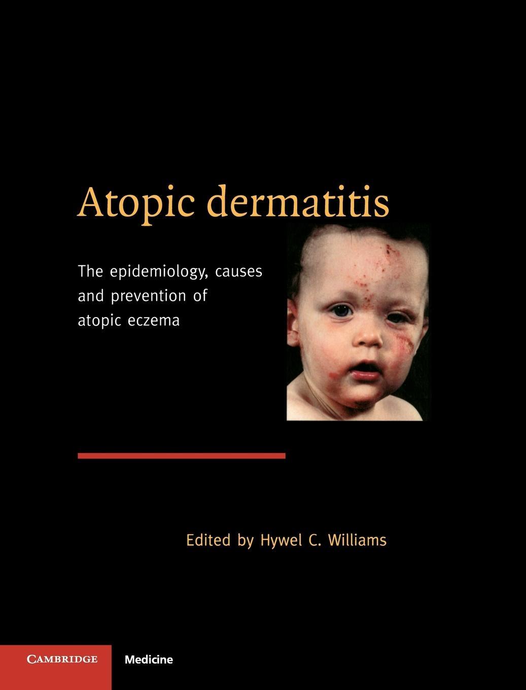 Cover: 9780521570756 | Atopic Dermatitis | Hywel C. Williams | Buch | Englisch | 2017