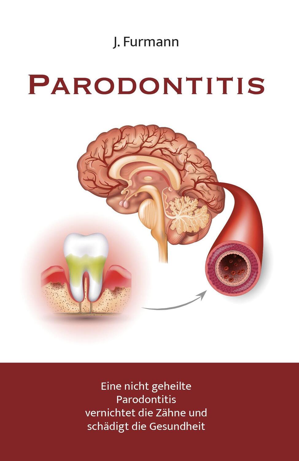 Cover: 9783962006679 | Parodontitis | J. Furmann | Taschenbuch | Deutsch | 2022