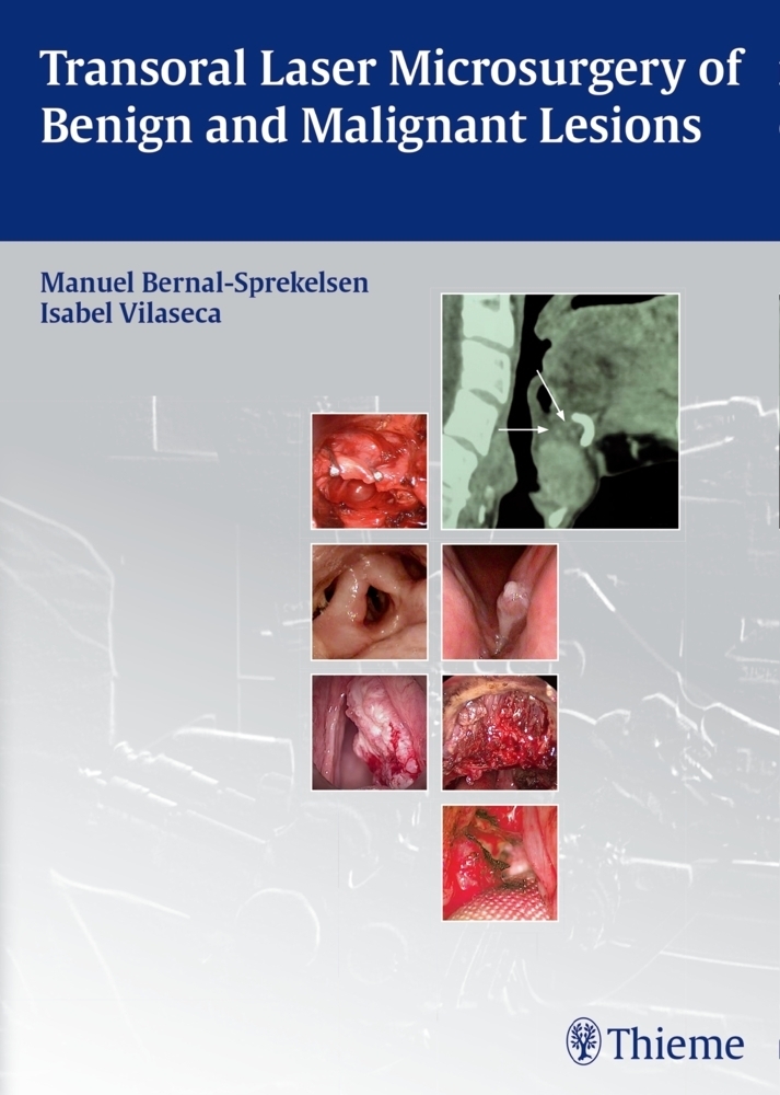 Cover: 9783131723918 | Transoral Laser Microsurgery of Benign and Malignant Lesions | Buch