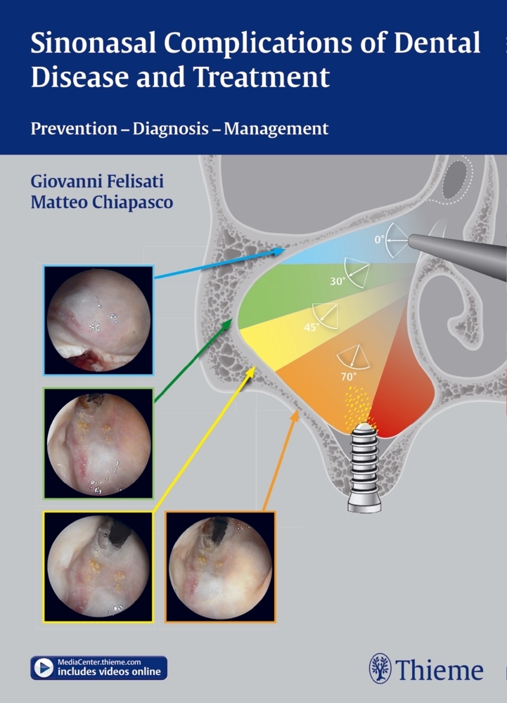 Cover: 9783131997012 | Sinonasal Complications of Dental Disease and Treatment | Buch | 2015