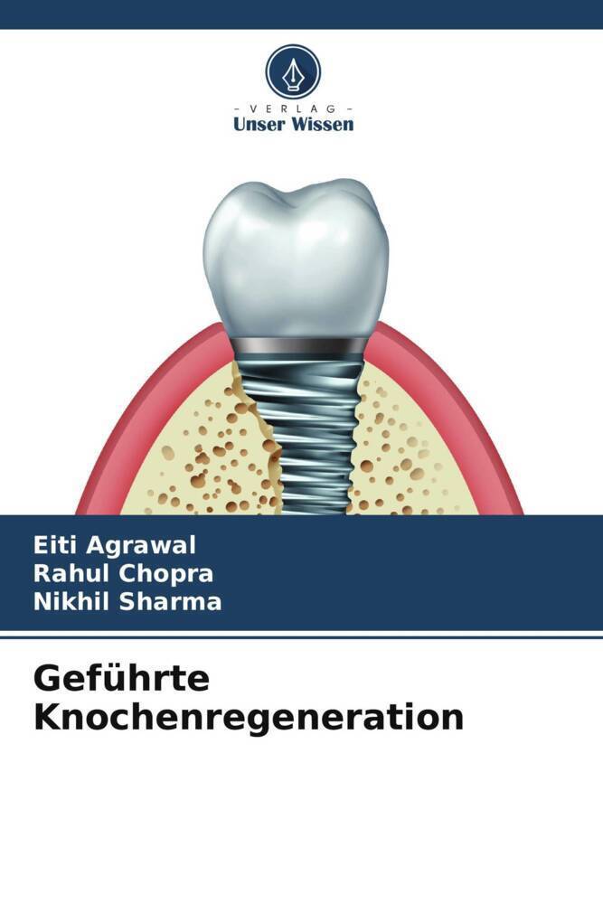 Cover: 9786204820842 | Geführte Knochenregeneration | Eiti Agrawal (u. a.) | Taschenbuch