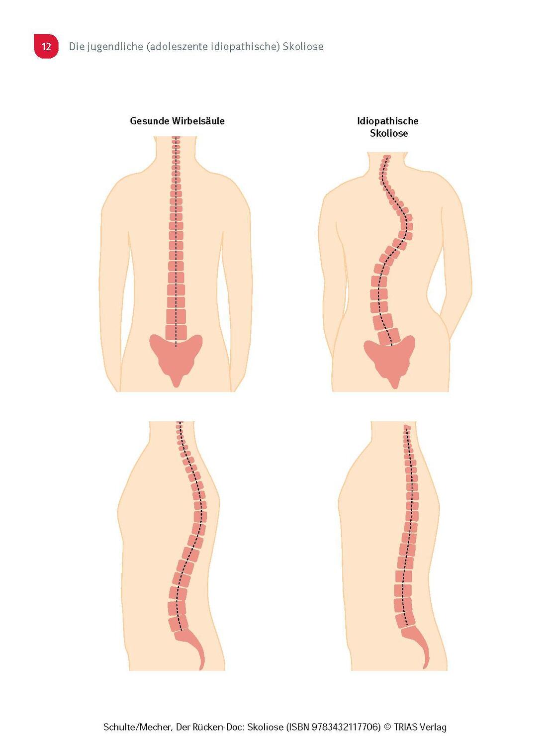 Bild: 9783432117706 | Der Rücken-Doc: Skoliose | Tobias L. Schulte (u. a.) | Taschenbuch