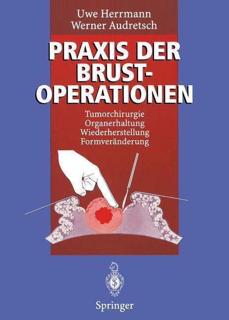 Cover: 9783642796098 | Praxis der Brustoperationen | Werner Audretsch (u. a.) | Taschenbuch