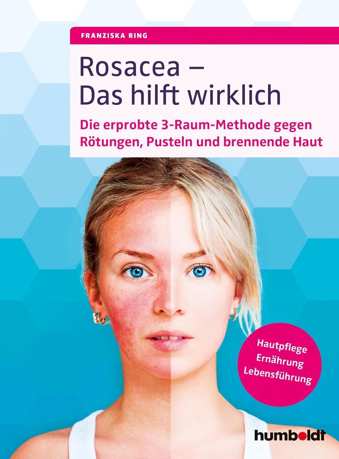 Cover: 9783869100524 | Rosacea - Das hilft wirklich | Franziska Ring | Taschenbuch | Deutsch