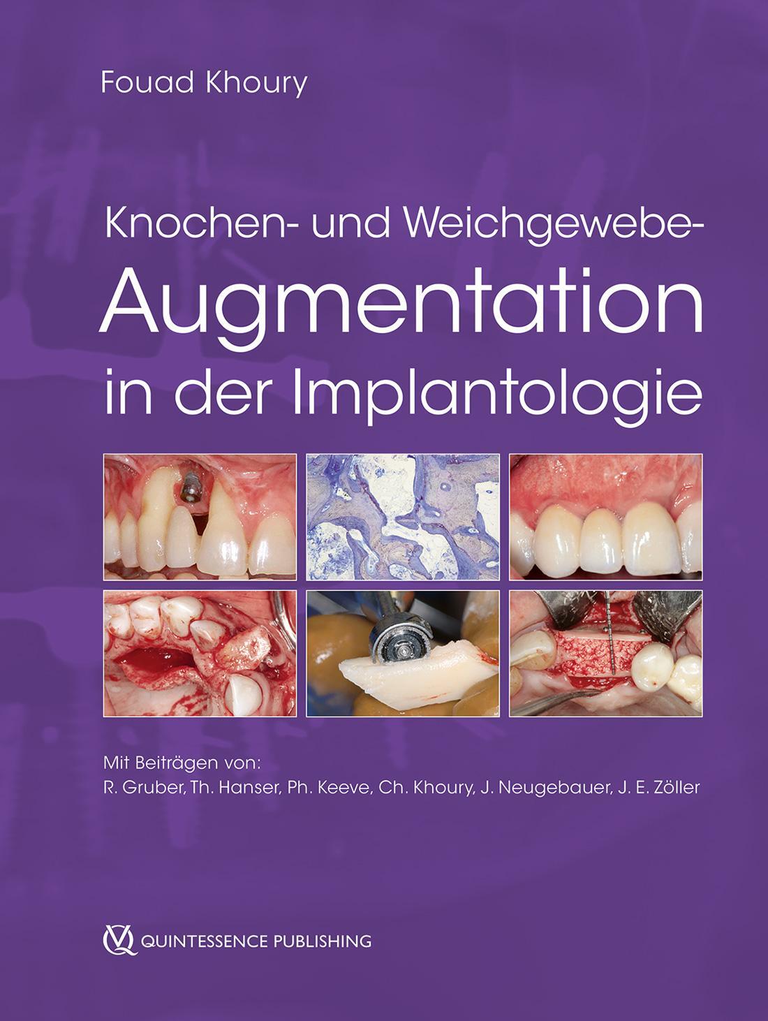 Cover: 9783868675979 | Knochen- und Weichgewebeaugmentation in der Implantologie | Khoury