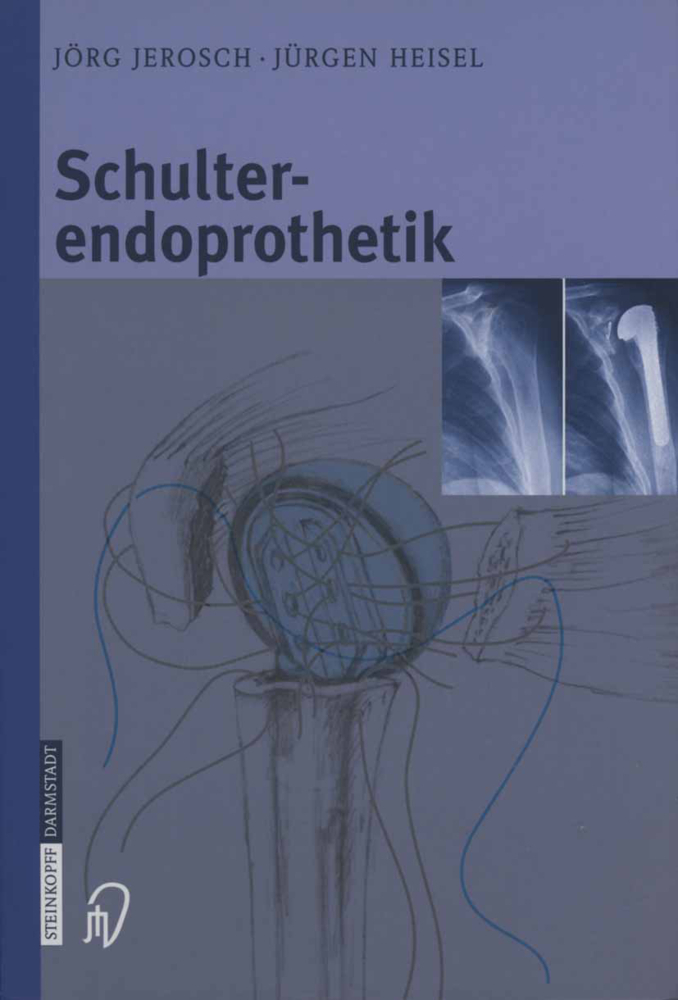 Cover: 9783642632938 | Schulterendoprothetik | Jörg Jerosch (u. a.) | Taschenbuch | XII
