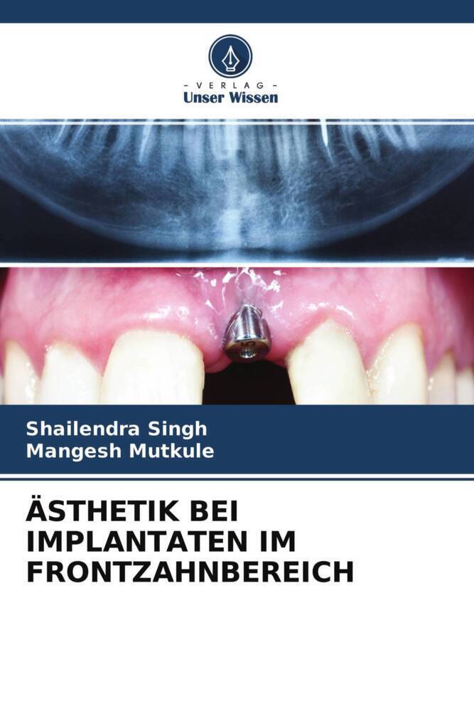 Cover: 9786204526010 | ÄSTHETIK BEI IMPLANTATEN IM FRONTZAHNBEREICH | Singh (u. a.) | Buch
