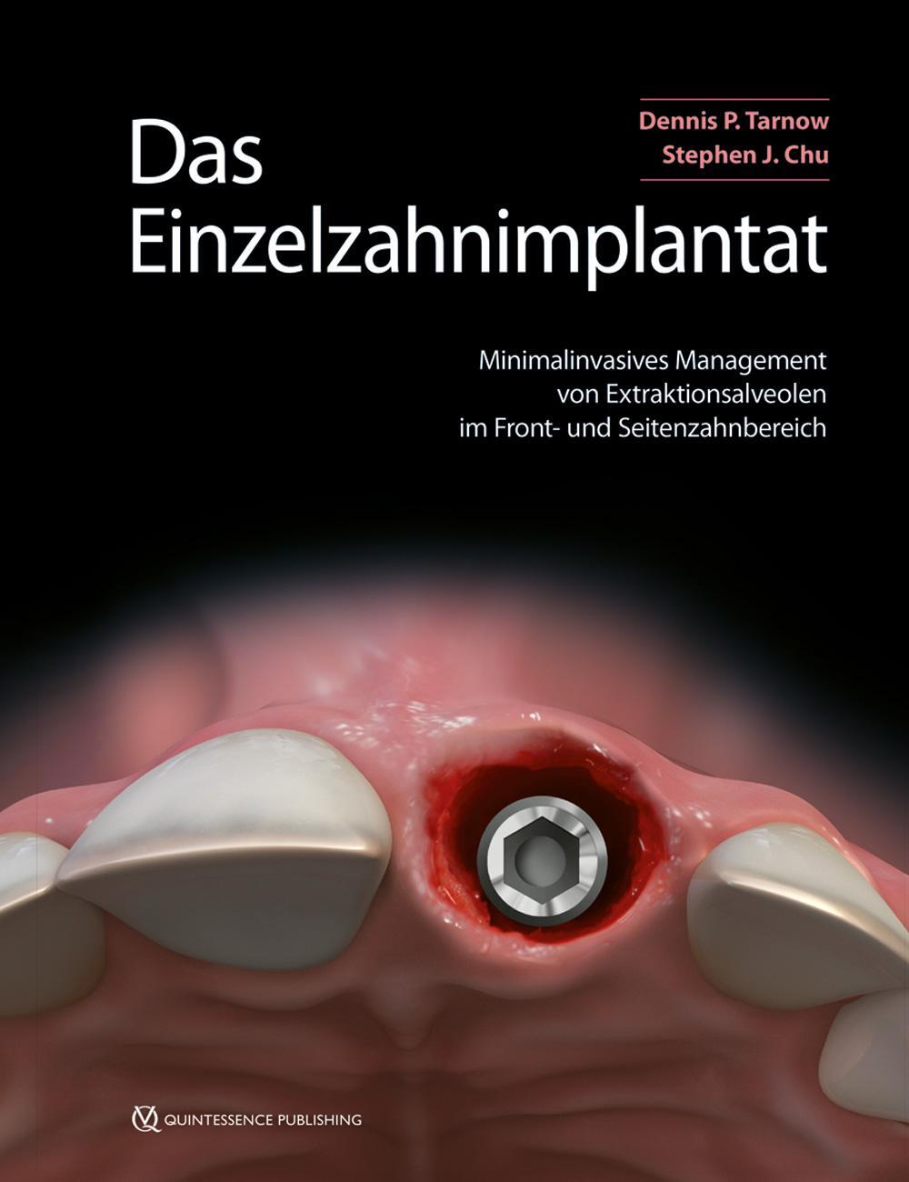 Cover: 9783868675344 | Das Einzelzahnimplantat | Dennis P. Tarnow (u. a.) | Buch | Deutsch