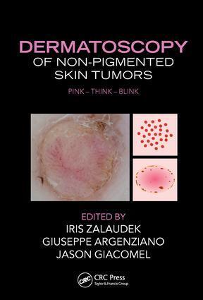 Cover: 9781482237528 | Dermatoscopy of Non-Pigmented Skin Tumors | Pink - Think - Blink