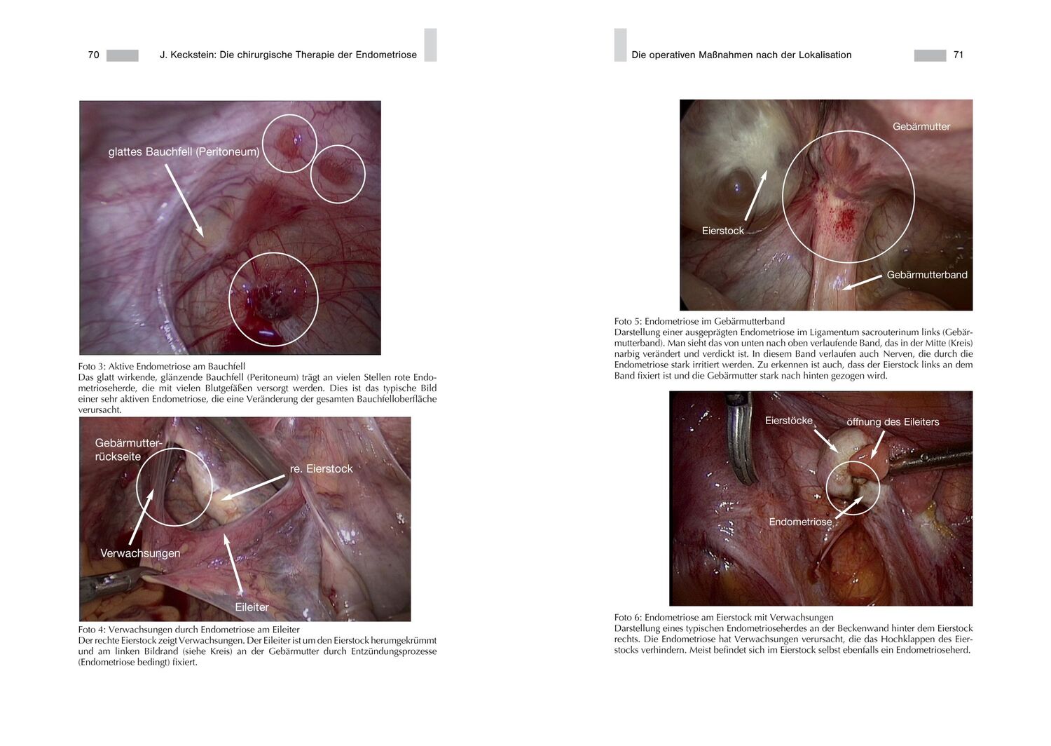 Bild: 9783938580738 | Endometriose - Die verkannte Frauenkrankheit | Jörg Keckstein | Buch