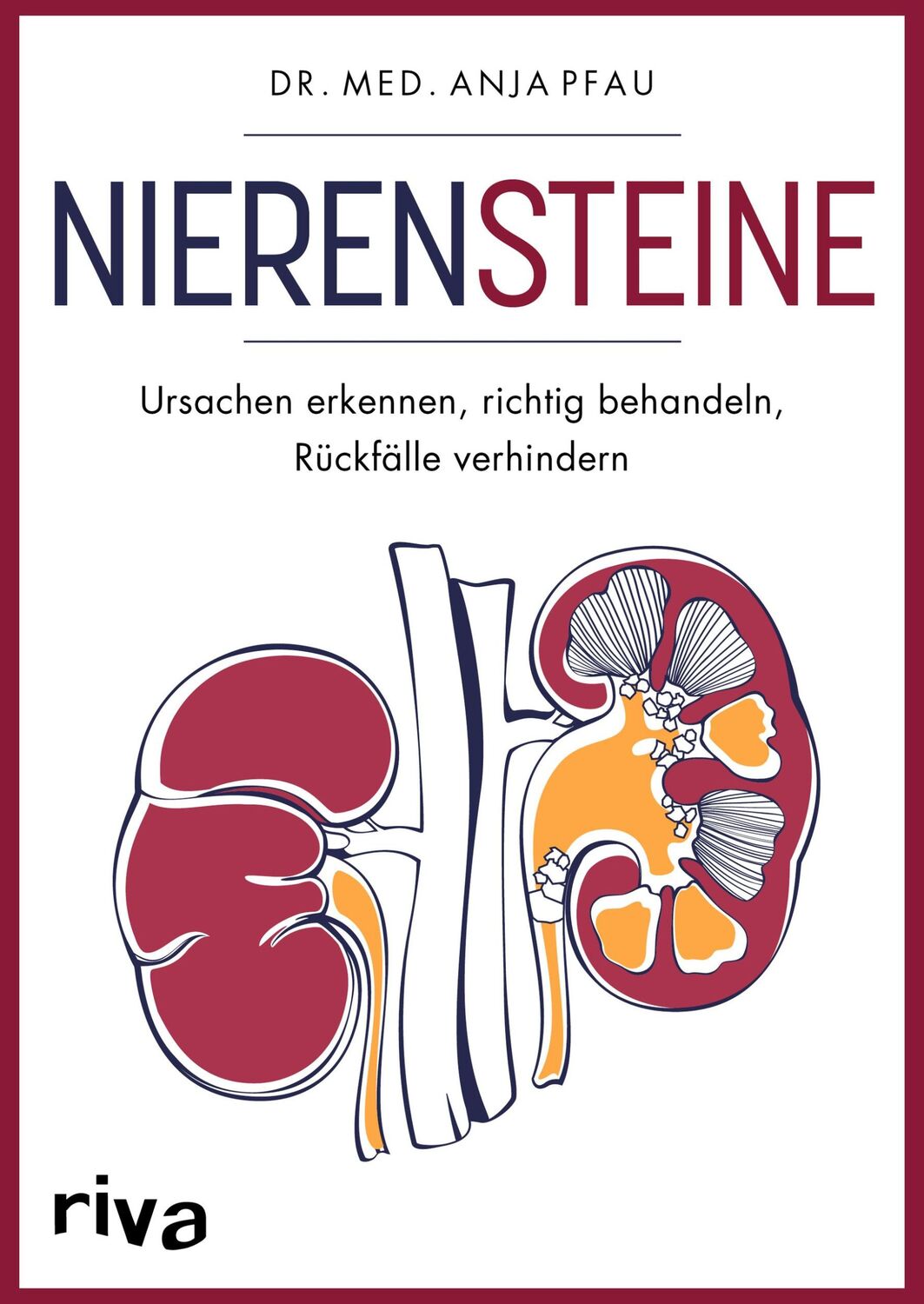 Cover: 9783742322685 | Nierensteine - Ursachen erkennen, richtig behandeln, Rückfälle...