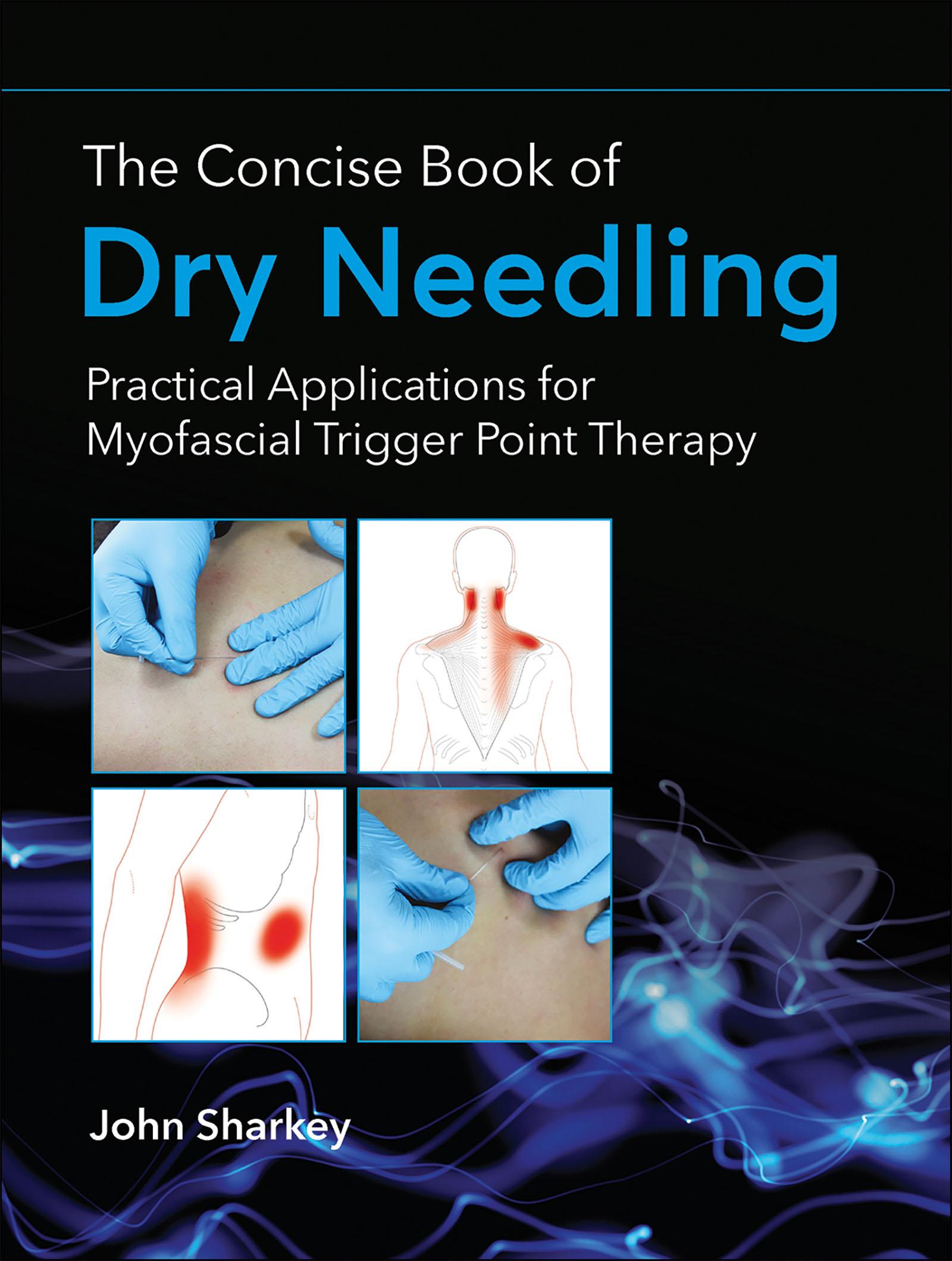 Cover: 9781905367672 | The Concise Book of Dry Needling | John Sharkey | Taschenbuch | 2016