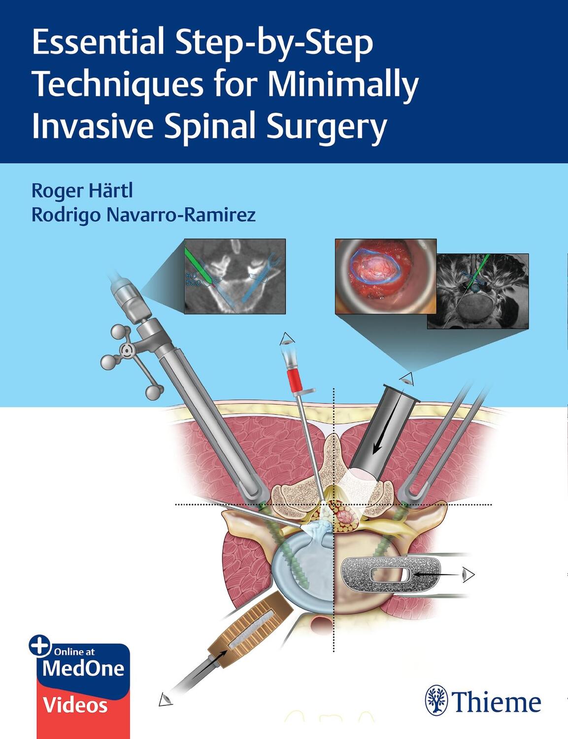 Cover: 9781684200092 | Essential Step-by-Step Techniques for Minimally Invasive Spinal...