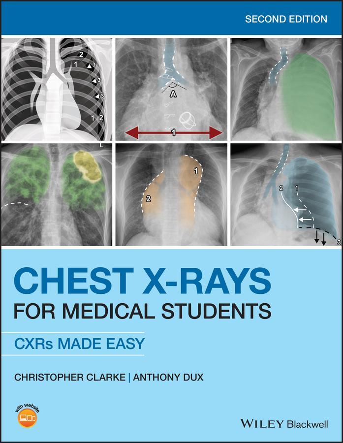 Cover: 9781119504153 | Chest X-Rays for Medical Students | Cxrs Made Easy | Clarke (u. a.)