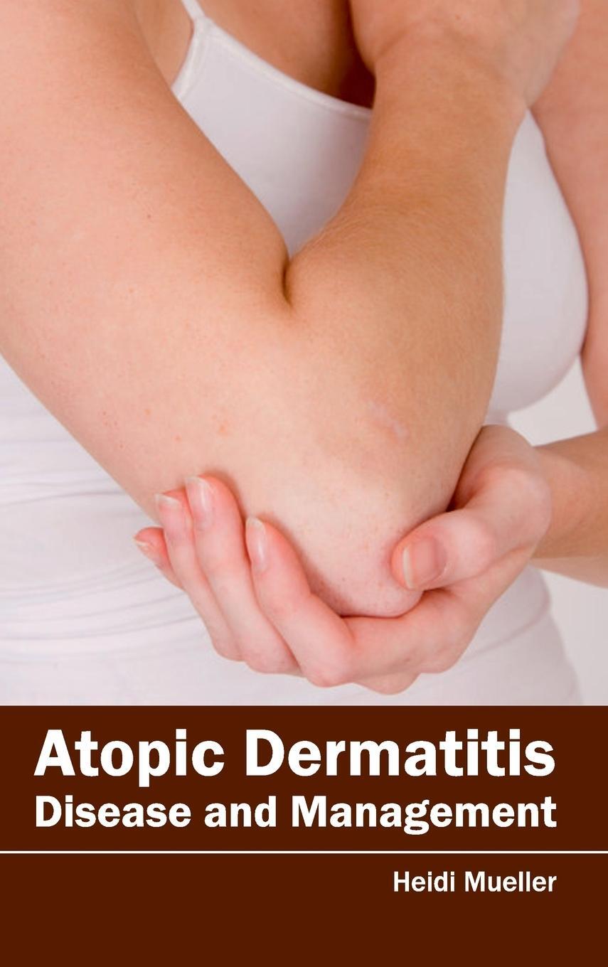 Cover: 9781632420589 | Atopic Dermatitis | Disease and Management | Heidi Mueller | Buch