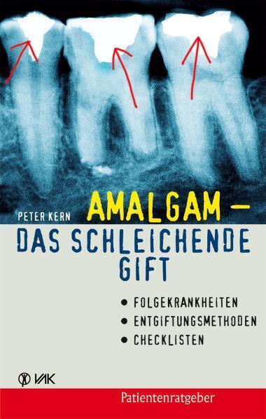 Cover: 9783867310062 | Amalgam - das schleichende Gift | Peter Kern | Taschenbuch