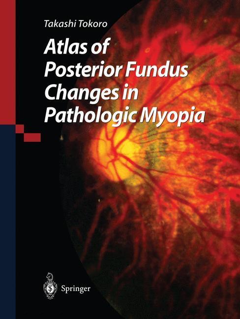 Cover: 9784431702252 | Atlas of Posterior Fundus Changes in Pathologic Myopia | Tokoro | Buch