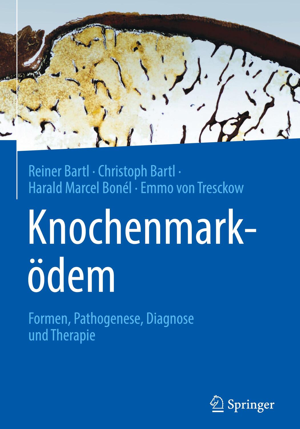 Cover: 9783662671337 | Knochenmarködem | Formen, Pathogenese, Diagnose und Therapie | Buch
