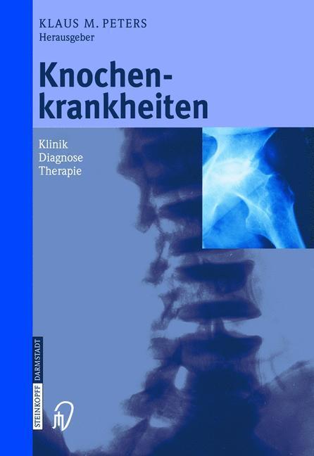 Bild: 9783798513259 | Knochenkrankheiten | Klinik Diagnose Therapie | Klaus M. Peters | Buch