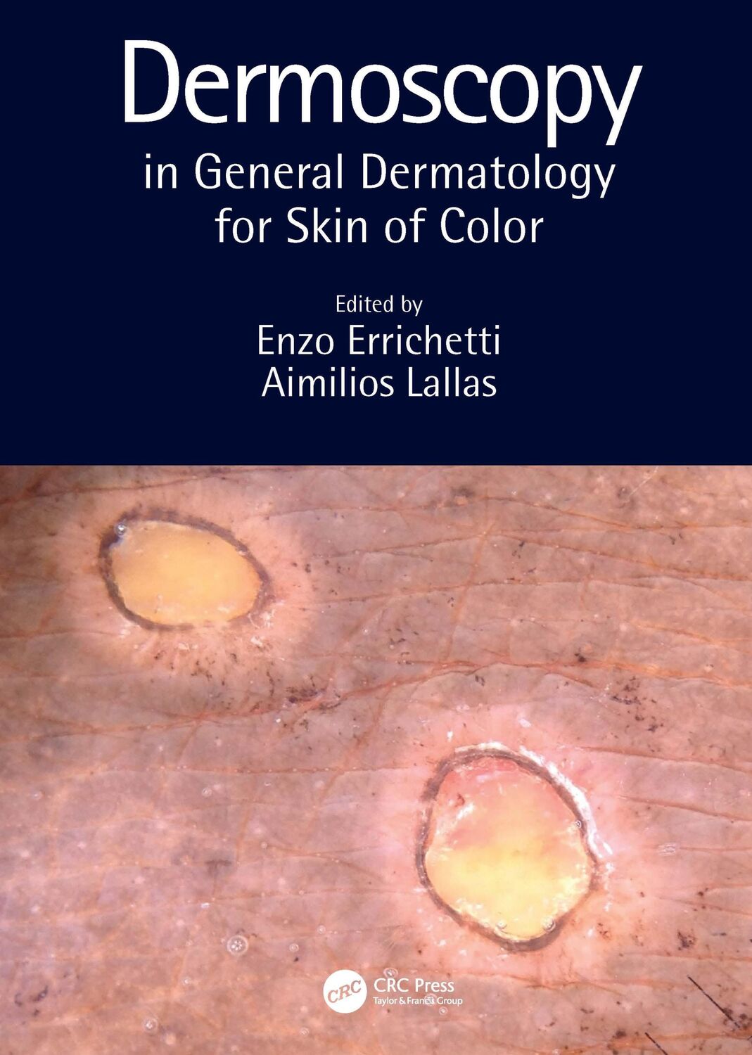 Cover: 9780367418403 | Dermoscopy in General Dermatology for Skin of Color | Lallas (u. a.)