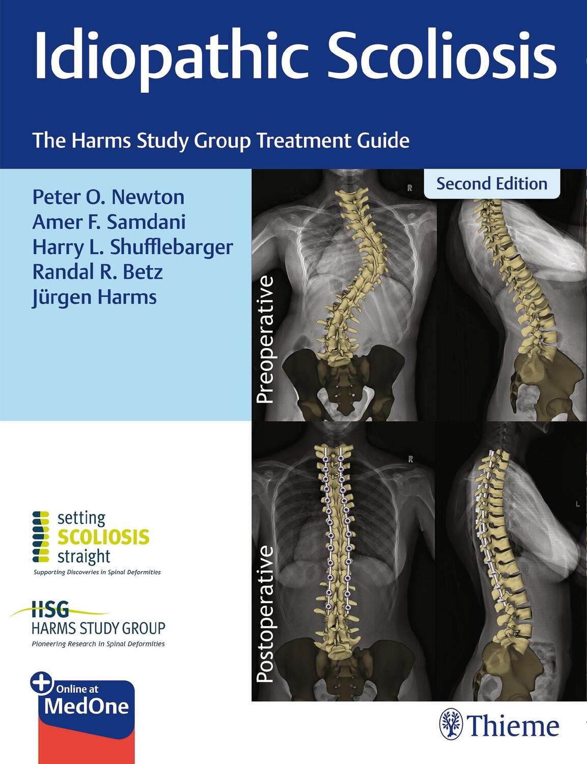 Cover: 9781684200559 | Idiopathic Scoliosis | The Harms Study Group Treatment Guide | Buch