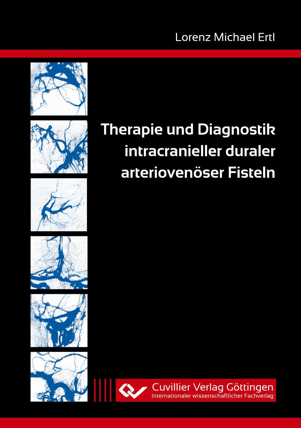 Cover: 9783736974760 | Therapie und Diagnostik intracranieller duraler arteriovenöser Fisteln