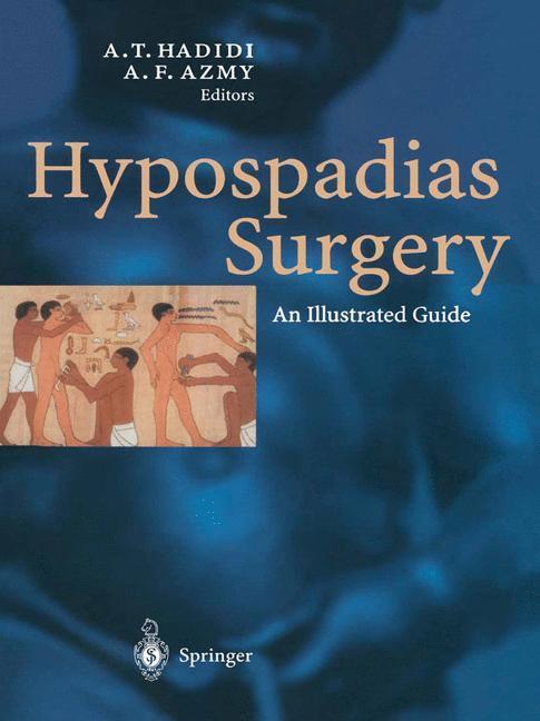 Cover: 9783662078433 | Hypospadias Surgery | An Illustrated Guide | A. (u. a.) | Taschenbuch