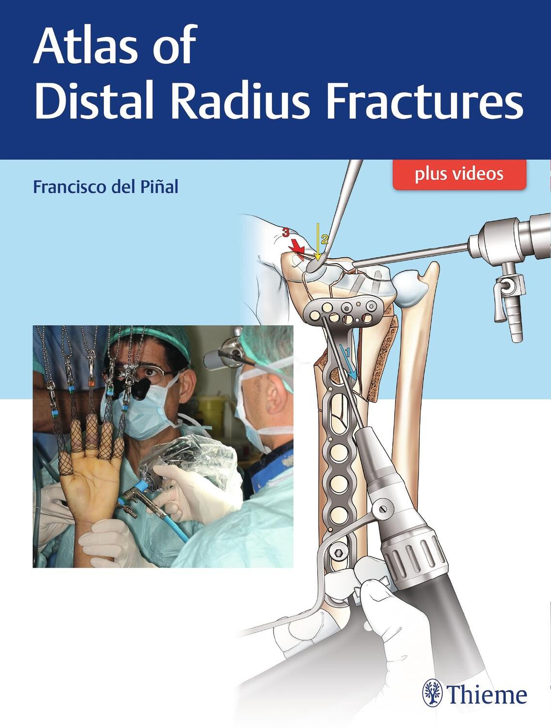 Cover: 9781626236790 | Atlas of Distal Radius Fractures | Francisco Del Pinal | Bundle | 2018