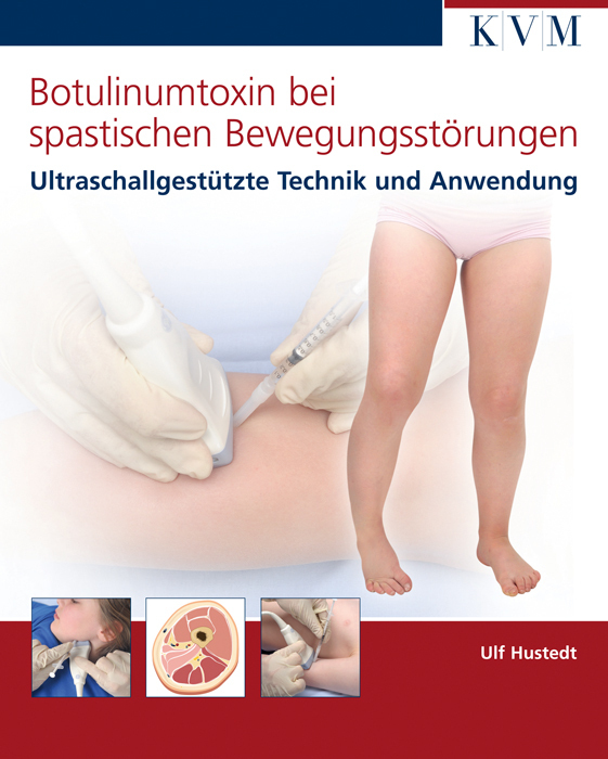 Cover: 9783940698193 | Botulinumtoxin bei spastischen Bewegungsstörungen | Ulf Hustedt | Buch